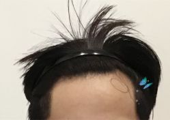 -大麦微针植发全国连锁