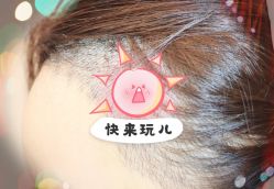 -大麦微针植发全国连锁