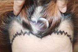 -大麦微针植发全国连锁