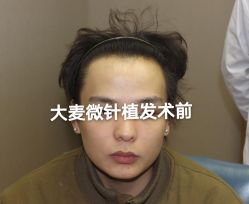 体验前-大麦微针植发全国连锁