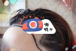 -大麦微针植发全国连锁