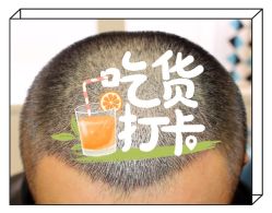 -大麦微针植发全国连锁