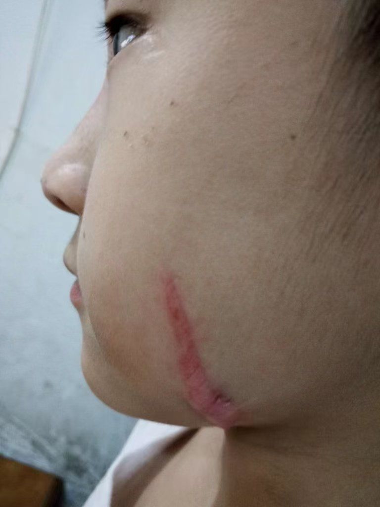 疤痕体质什么原因