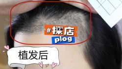 -大麦微针植发全国连锁