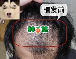 -大麦微针植发全国连锁