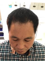 -大麦微针植发全国连锁