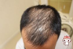 -大麦微针植发丨全国连锁