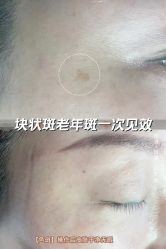 -清疣美疣·痣·斑净肤中心