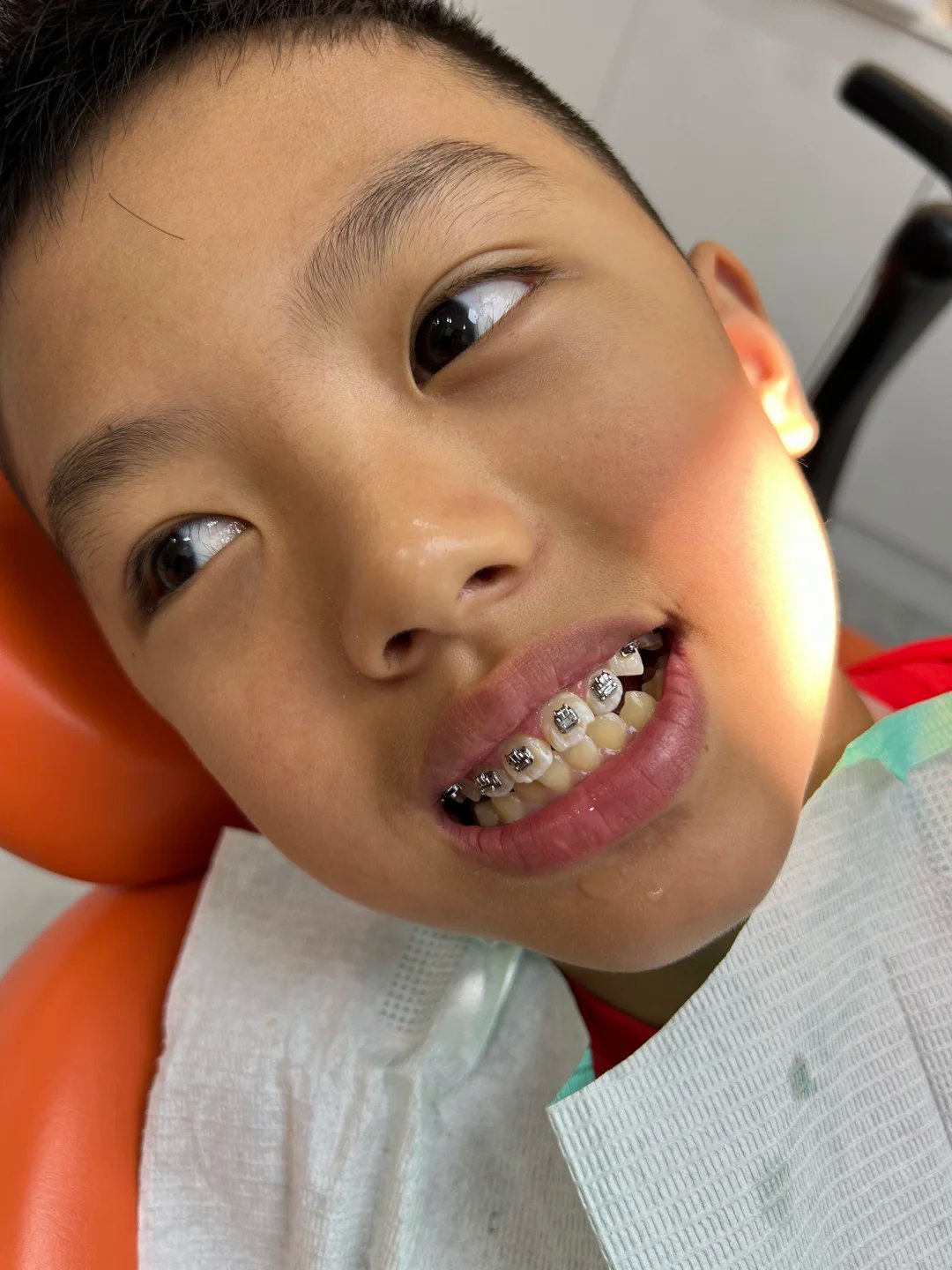 10岁天包地牙齿矫正经验分,不做无用功!