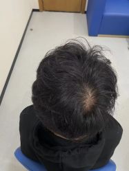 -大麦微针植发全国连锁