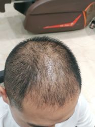 -碧莲盛·不剃发植发