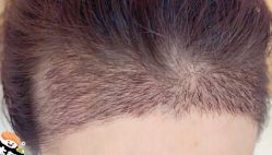 -大麦微针植发丨全国连锁