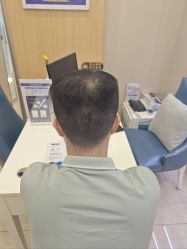 -大麦微针植发全国连锁