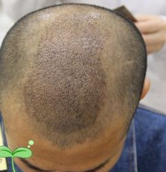 -大麦微针植发丨全国连锁