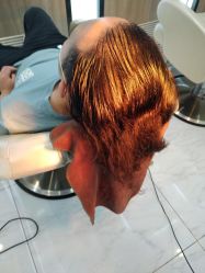 -大麦微针植发丨全国连锁