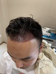 -大麦微针植发丨全国连锁