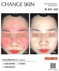 -倩极·精研痘敏肌管理