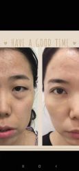 体验前-新美荟医美·专注面部美学抗衰