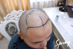 点击看大图 体验后-大麦微针植发全国连锁