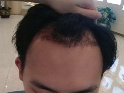 -大麦微针植发丨全国连锁