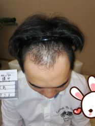 -大麦微针植发丨全国连锁