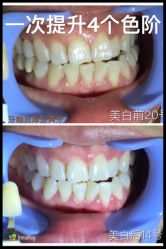 光Spa 牙齿白也是一种美[馋嘴][馋嘴][馋嘴]-光SPA科技美肤