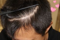 -大麦微针植发丨全国连锁