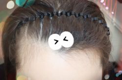 -大麦微针植发全国连锁