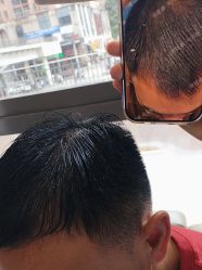 -碧莲盛·不剃发植发