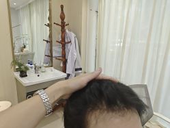 -碧莲盛·不剃发植发