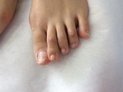 -德哥灰指甲脚气甲沟炎跖疣护理