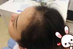 -大麦微针植发丨全国连锁