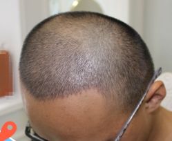 -大麦微针植发丨全国连锁