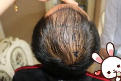 -大麦微针植发丨全国连锁