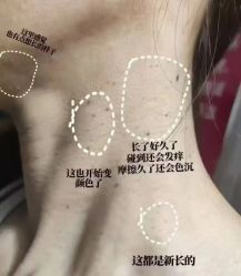 -瑶芳清颜草本祛痘