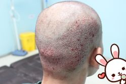 -大麦微针植发丨全国连锁