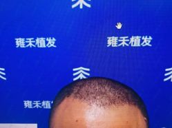 -雍禾植发全国连锁