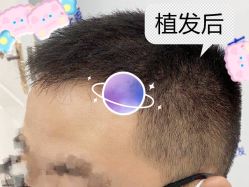 -大麦微针植发全国连锁