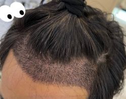 -大麦微针植发全国连锁