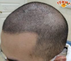 -大麦微针植发丨全国连锁