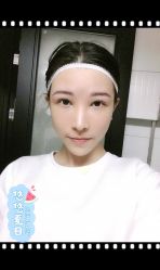 点击看大图 体验后-大麦微针植发全国连锁