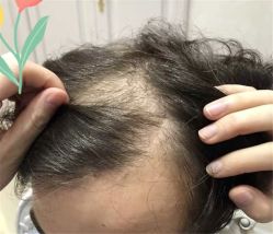 点击看大图 -大麦微针植发全国连锁