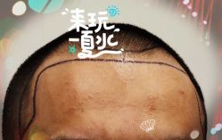-大麦微针植发全国连锁