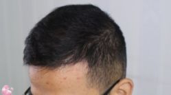 -大麦微针植发丨全国连锁