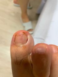 -德哥灰指甲脚气甲沟炎跖疣护理