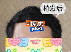 -大麦微针植发全国连锁