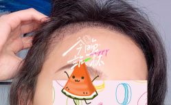 -大麦微针植发全国连锁