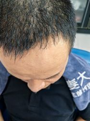 -大麦微针植发全国连锁