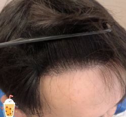 -大麦微针植发丨全国连锁