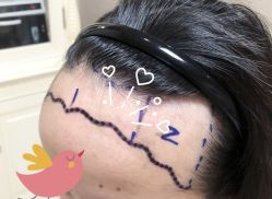 -大麦微针植发全国连锁